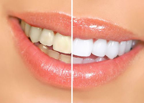Tẩy trắng răng có đau hay ảnh hưởng gì không?