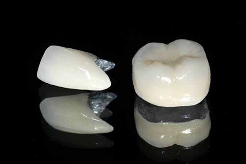 Răng sứ kim loại có chi phí thấp