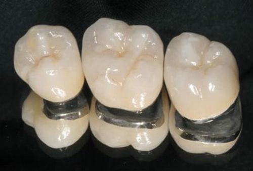 Răng sứ kim loại có chi phí thấp