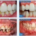 Hình ảnh trước và sau điều trị sâu răng