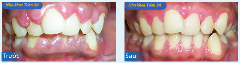 Hình ảnh trước và sau điều trị viêm chân răng
