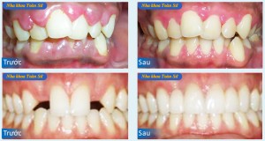 Hình ảnh điều trị viêm chân răng