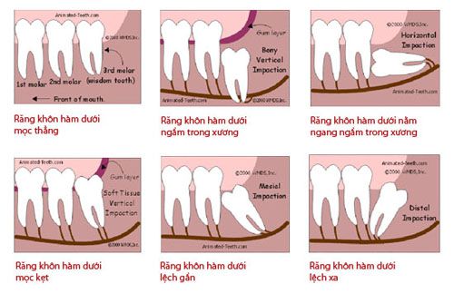 Nhổ răng có đau không