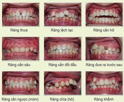 Niềng răng không mắc cài