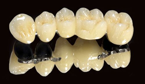 So sánh răng sứ titan với sứ E.max