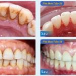 Hình ảnh trước và sau cạo vôi răng