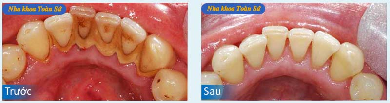 Hình trước và sau Cạo vôi răng