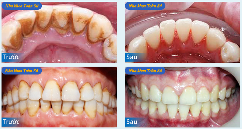 Hình ảnh trước và sau cạo vôi răng