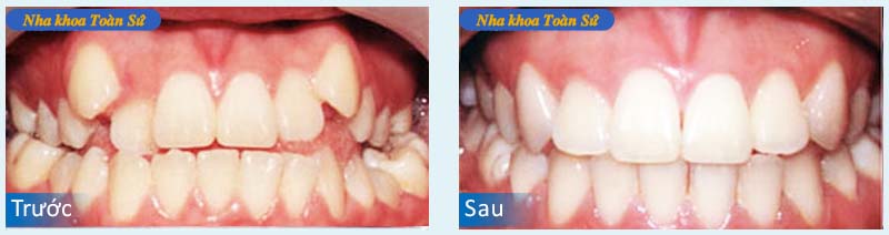Hình trước và sau khin niềng răng invisalign