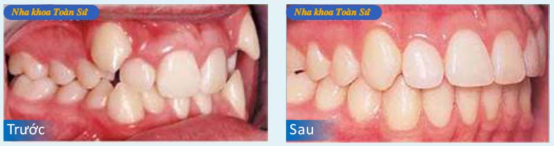 Hình trước và sau khi niềng răng