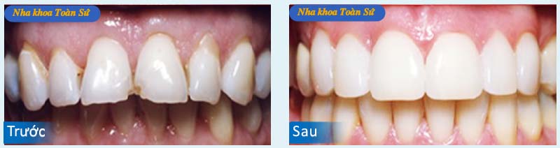 Hình trước và sau làm răng toàn sứ