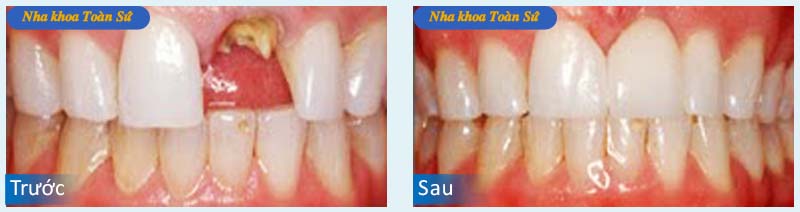 Hình trước và sau khi làm răng sứ Cercon