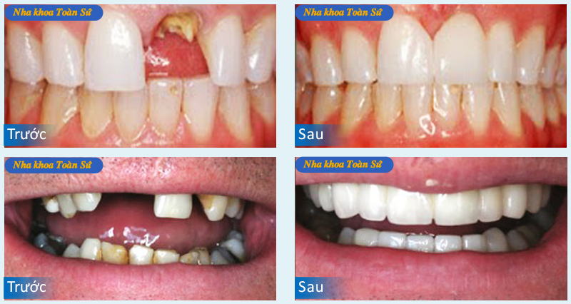 Hình trước và sau làm răng sứ Cercon