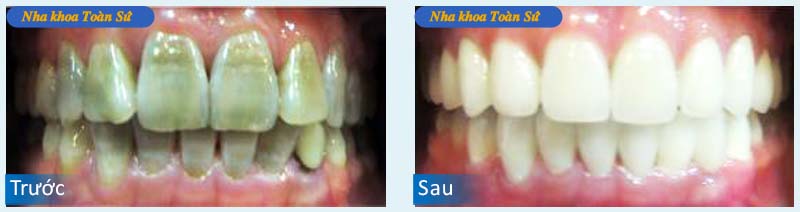 Hình trước và sau khi làm răng sứ không kim loại E.MAX