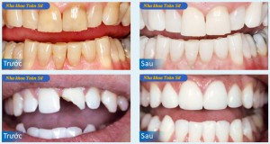 Hình răng sứ không kim loại
