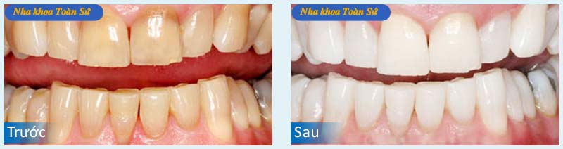 Hình trước và sau khi làm răng sứ không kim loại