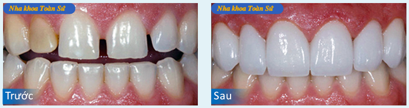 Hình trước và sau làm răng sứ Titan