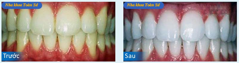 Hình trước và sau Tẩy trắng răng