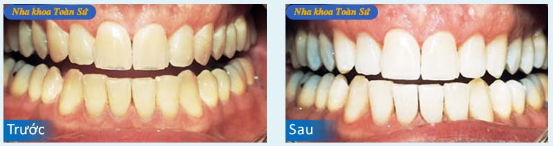 Hình trước và sau Tẩy trắng răng 
