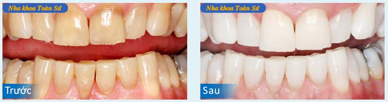 Hình trước và sau Tẩy trắng răng