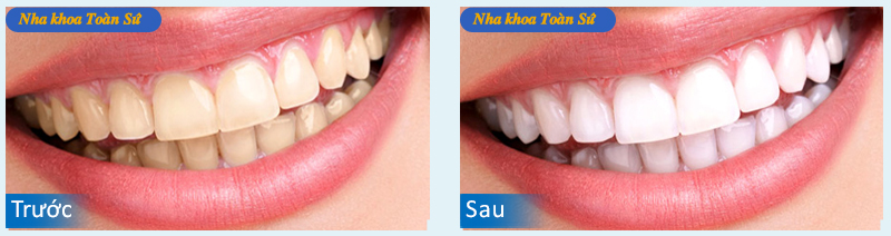 Hình ảnh trước và sau tẩy trắng răng
