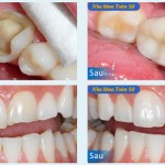 Hình ảnh trước và sau trám răng