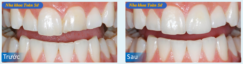 Hình ảnh trước và sau trám răng