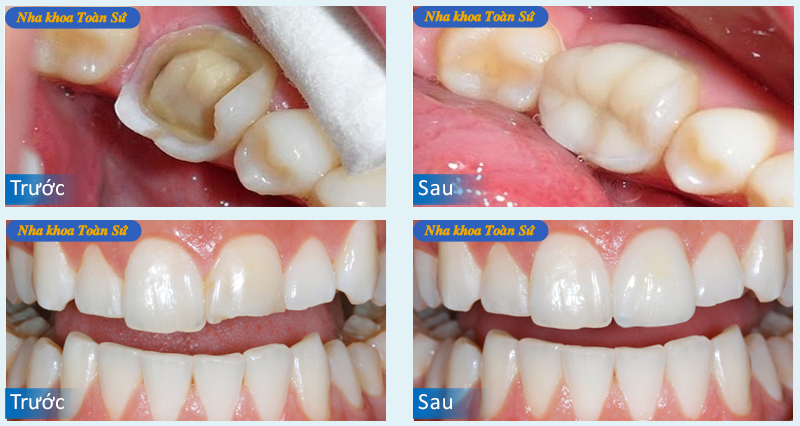 Giật mình hình ảnh sâu răng TRƯỚC và SAU khi điều trị