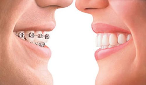 Quy trình niềng răng như thế nào