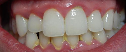 Bệnh sâu răng là gì ?