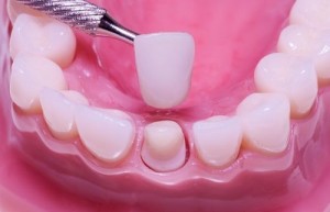 Cầu răng sứ sử dụng được bao lâu ?