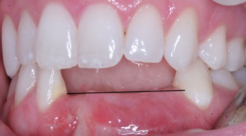 Cấy ghép implant là gì
