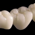 Cấy ghép implant phục hình răng sứ
