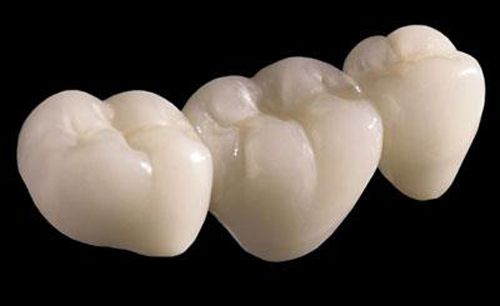 Cấy ghép implant phục hình răng sứ
