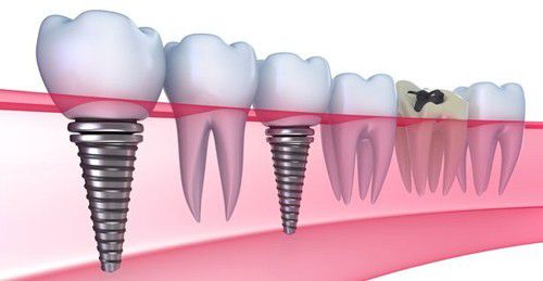 Chăm sóc răng implant như thế nào