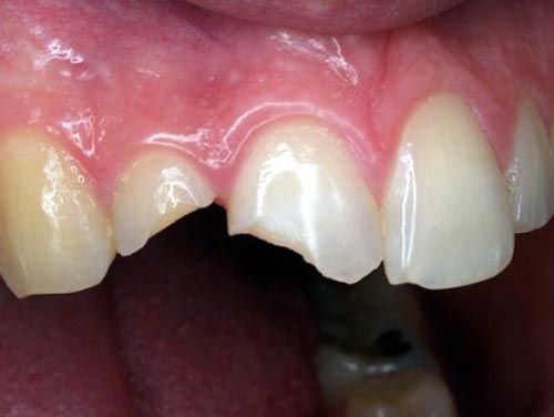 Mão răng và cầu răng là gì 