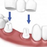 Mão răng và cầu răng là gì