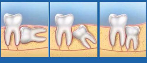 Nhổ răng có ảnh hưởng đến sức khỏe không ?