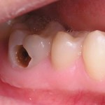 Nhổ răng sâu có đau không