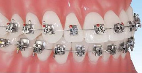 Niềng răng chỉnh nha với phương pháp gắn mắc cài