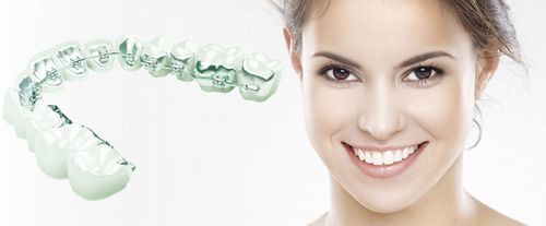 Niềng răng chỉnh nha với phương pháp gắn mắc cài
