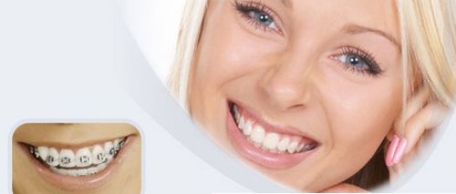 Niềng răng ở đâu tốt mà giá cả lại phải chăng
