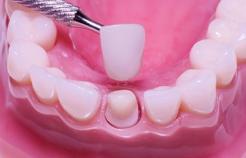 Quy trình lắp cầu răng như thế nào ?