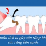Tại sao cần phải nhổ răng khôn