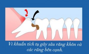 Tại sao cần phải nhổ răng khôn