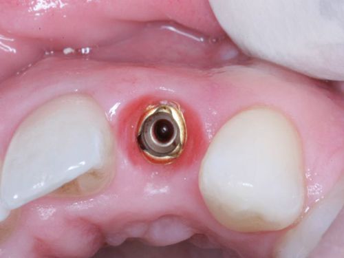 Tỉ lệ thành công của cấy ghép implant
