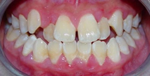 Trong trường hợp nào nên dán mặt răng sứ veneer 