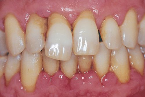 Bệnh nha chu không chỉ gây mất răng