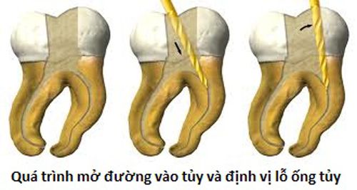 Bệnh sâu răng và cách khắc phục