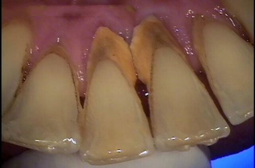 Nguyên nhân gây sâu răng là gì ?